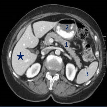 Fin du détour et direction l'abdomen pour trois questions, illustrées toutes les trois par trois scanners en vue du dessous.Quelle glande digestive est annotée à l'aide de l'étoile bleue ?