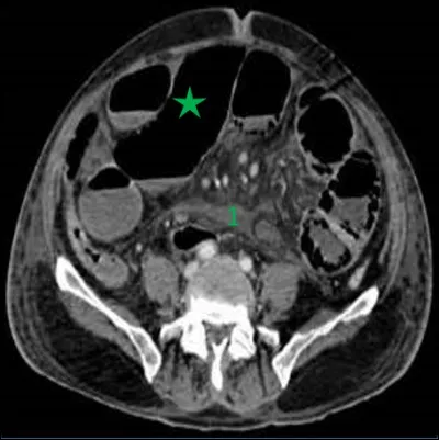 On reste sur l'abdomen avec cette question.
A quel niveau du tube digestif se trouve-t-on au niveau de l'étoile verte ?