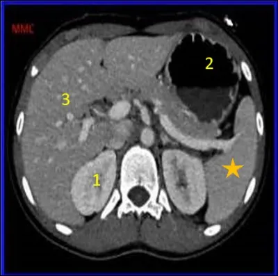 On termine notre visite de l'abdomen avec cette question.
Comment se nomme le filtre sanguin marqué d'une étoile orange ?