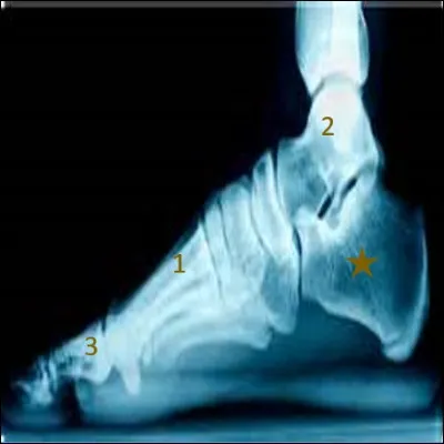Et on termine ce quiz avec le pied via cette radiographie en vue du côté.
Comment se nomme l'os marqué par une étoile marron ?