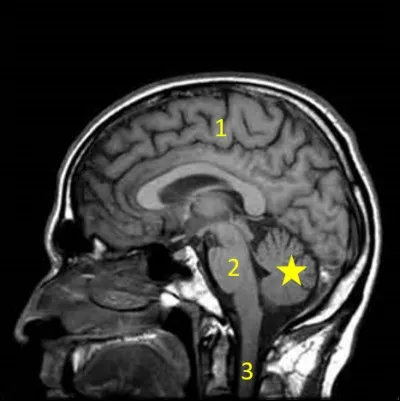On zoome un peu pour se concentrer sur le système nerveux central. 
Quel est cet organe, fort utile à notre équilibre, marqué par l'étoile jaune ?