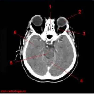 On descend encore un peu pour arriver à la face, via ce scanner en vue de dessous. 
Quelle flèche désigne notre nez ?