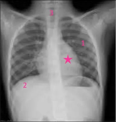 Nous voici dans une région vitale : le thorax. Vu ici via une radiographie de face. 
Quel organe, indispensable à la vie, est marqué d'une étoile rose ?