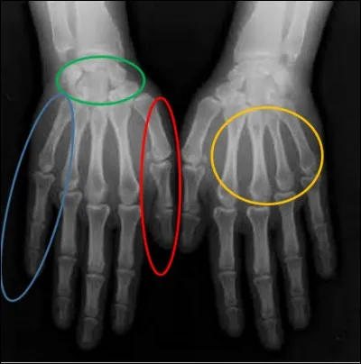 Avant de regagner le tronc, petite halte à la main avec une radio de face.
Quelle est la région encadrée de vert ?