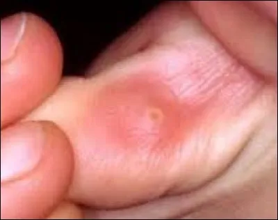 Où se développe un il de perdrix ?