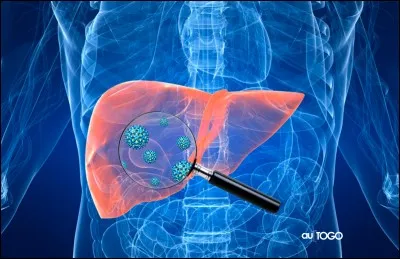 L'infection chronique par le virus de l'hépatite B ...