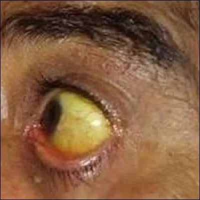 Lors d'une hépatite virale aiguë le patient peut présenter ...