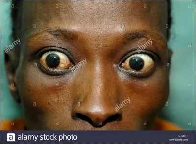 Dans la maladie de Basedow on peut trouver les symptômes suivants :