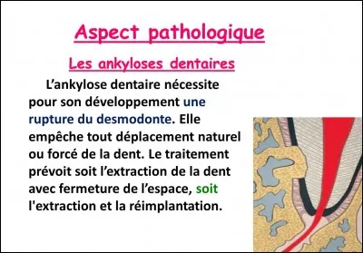 L'ankylose correspond à une...