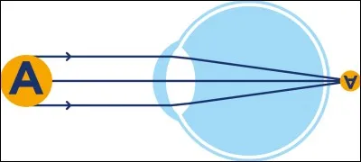 Comment corrige-t-on l'hypermétropie, le défaut qui perturbe la vision d'un objet proche ?