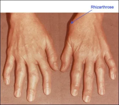 L'arthrose du pouce," la rhizarthrose"est d'origine mécanique ou d'une activité qui a trop sollicité le pouce.S'ajoutent à l'atteinte ... .
