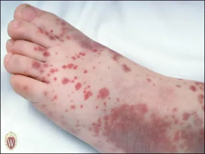 Une petite tache rouge sur la peau, caractéristique du purpura est