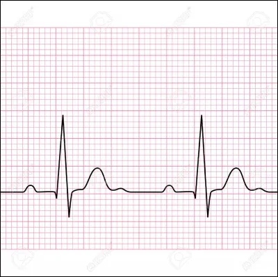 Donnez l'ordre des 5 phases du cycle cardiaque : 
a) diastole 
b) systole oriculaire 
c) systole ventriculaire isotonique 
d) systole ventriculaire isovolumétrique
e) relâchement isovolumétrique