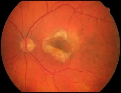 La macula est une dépression de la rétine. Elle est également appelée "tache blanche".