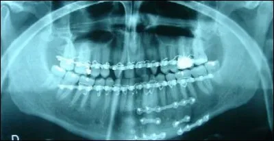 Quel est votre diagnostic après avoir regardé cette radiographie ?