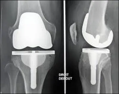 Quelle type de prothèse voyez-vous sur cette radiographie ?