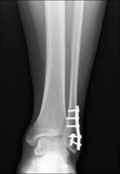 Sur cette radio, quel os a été ostéosynthésé ?