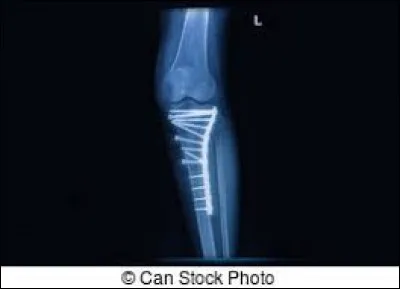 Suite à une chute en skateboard, Jérémy a dû être opéré.
Quel os le chirurgien a-t-il réparé avec une plaque et de nombreuses vis ?