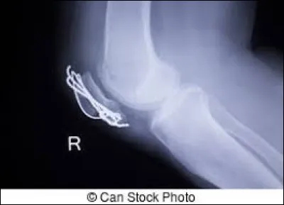 Que voyez-vous sur cette radiographie ?