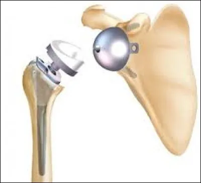 Quels sont les deux os concernés par cette prothèse ?