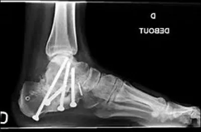 Mon grand-père est tombé du toit. Le chirurgien a du lui mettre des vis. Quelle partie du corps s'est-il fracturé ?