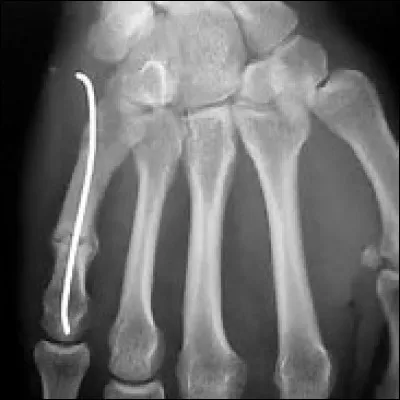 Dans quel os situez-vous la broche visible sur cette radiographie ?