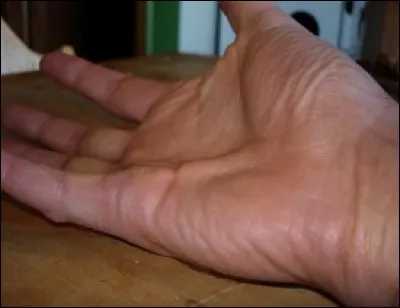 Qu'est-ce que la maladie de Dupuytren ?