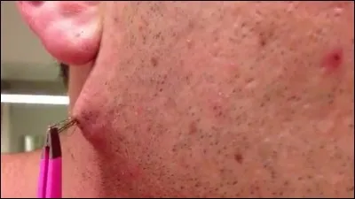 Comment nomme-t-on un poil quand il pousse entortillé sous la peau ?