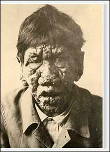 O taient envoys les lpreux ?