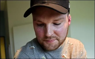 Quel était le pourcentage de brûlure sur cet homme de 33 ans?