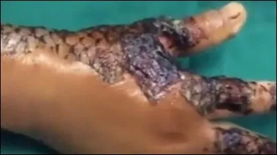 Sur quelle partie du corps n'a-t-on pas prélevé de peau chez le frère jumeau ?