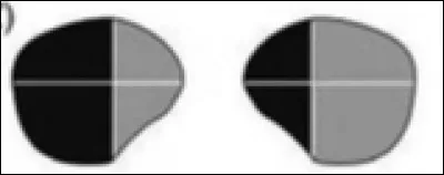 A quelle lésion correspond cette atteinte ?