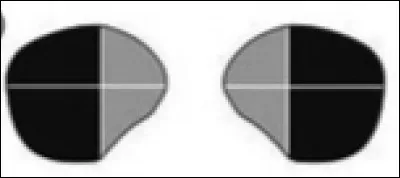 A quelle lésion correspond cette atteinte ?