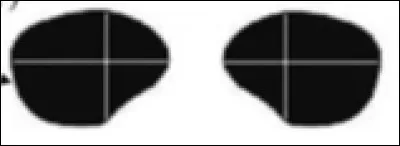 A quelle lésion correspond cette atteinte ?