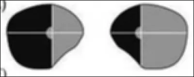 A quelle lésion correspond cette atteinte ?