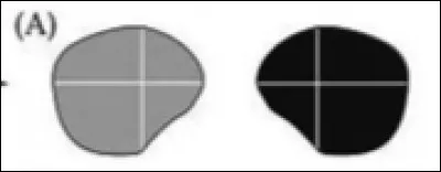 A quelle lésion correspond cette atteinte ?