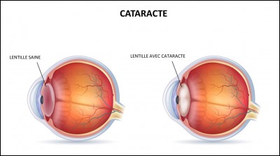Qu'est-ce que la cataracte?