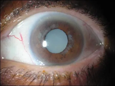 Quel est l'un des symptômes de la cataracte ?