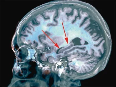 Que provoque l'Alzheimer sur un cerveau ? Le plus précisément possible.