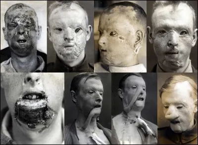 Comment appelle-t-on les soldats ayant une tête déformée ?