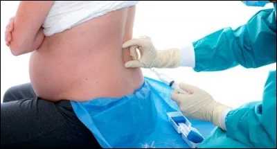 Comment s'appelle la piqûre qui permet d'anesthésier le bas du corps de la femme avant l'accouchement ?