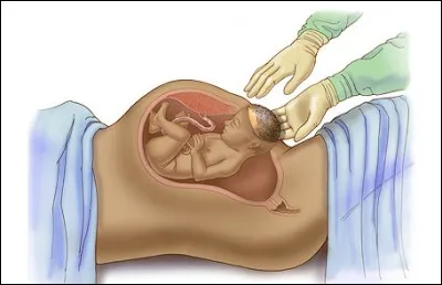 Quelle "raison" ne peut pas être à l'origine d'un accouchement par césarienne ?