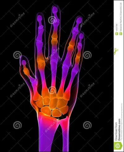 Comment s'appelle l'inflammation des articulations ?