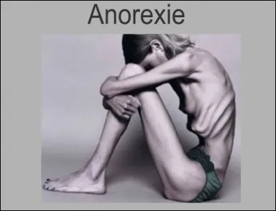 La fille d'un Président de la république a également été atteinte d'anorexie. Qui est ce président ?