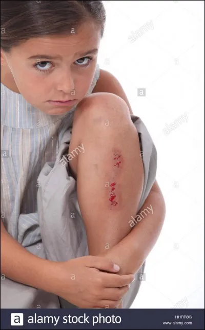 Je suis tomb&eacute; &agrave; v&eacute;lo, j'ai donc d&ucirc; prendre des b&eacute;qu...s pour marcher normalement.