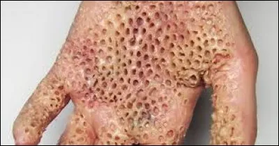 Selon l'expression commune, "se faire trouer la peau" équivaut à ...