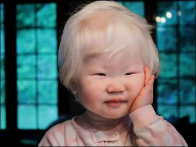 Laquelle de ces maladies se caractérise essentiellement par une quasi-absence de production de la mélanine ?