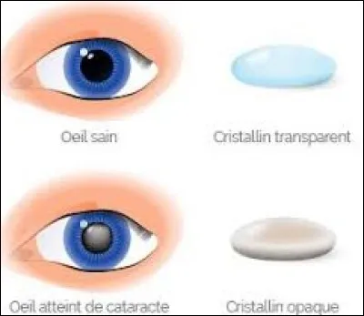La cataracte est une opacification du cristallin qui empêche les rayons lumineux d'arriver sur la rétine :