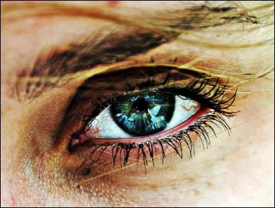 Quelle maladie est liée à l'opacification partielle ou totale du cristallin ?