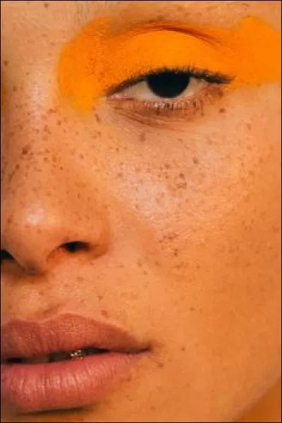 Quel est le nom médical des taches de rousseur ?